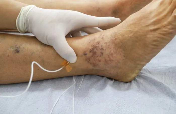 Tratamento de Varizes no Hospital de Petrolina: 2 Mil Pacientes Beneficiados Tratamento de Varizes no Hospital de Petrolina: 2 Mil Pacientes Beneficiados